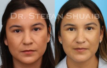 female patient before and after Rhinoplasty