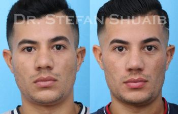 male patient before and after Rhinoplasty