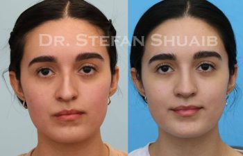 female patient before and after Rhinoplasty