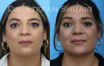 female patient before and after Rhinoplasty