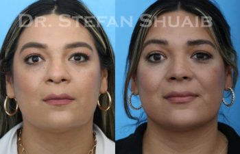 female patient before and after Rhinoplasty