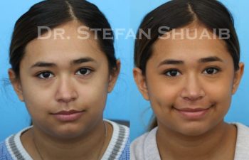 female patient before and after Rhinoplasty