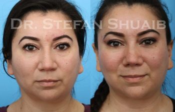 female patient before and after Rhinoplasty