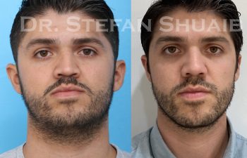 male patient before and after Rhinoplasty