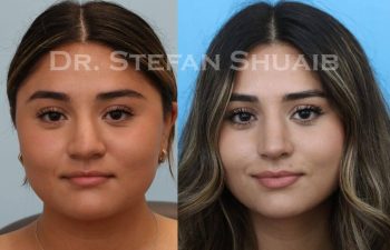 female patient before and after Rhinoplasty