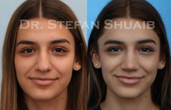 female patient before and after Rhinoplasty