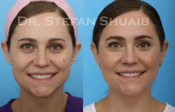 female patient before and after Rhinoplasty