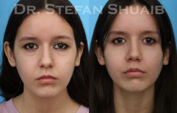 female patient before and after Rhinoplasty