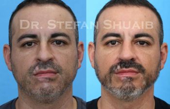 male patient before and after Rhinoplasty