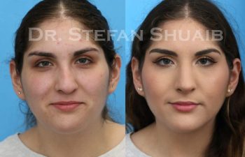 female patient before and after Rhinoplasty