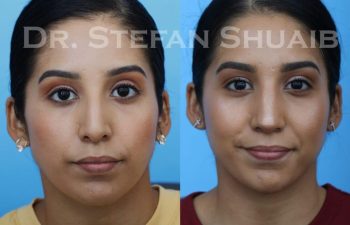 female patient before and after Rhinoplasty