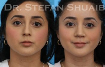 female patient before and after Rhinoplasty