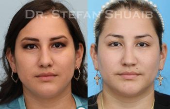 female patient before and after Rhinoplasty