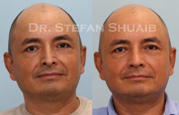 male patient before and after Rhinoplasty