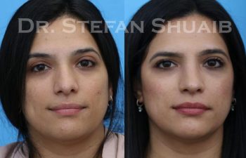 female patient before and after Rhinoplasty