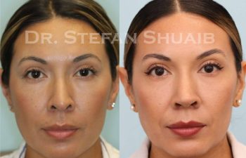 female patient before and after Rhinoplasty