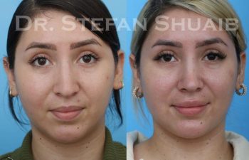 female patient before and after Rhinoplasty