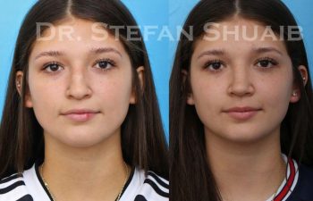 female patient before and after Rhinoplasty