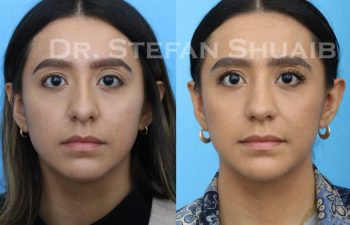 female patient before and after Rhinoplasty