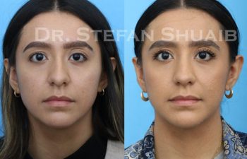 female patient before and after Rhinoplasty