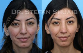 female patient before and after Rhinoplasty