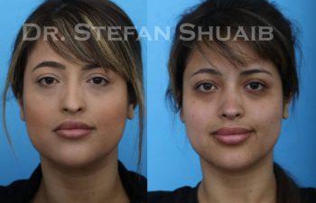 female patient before and after Rhinoplasty