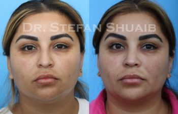 female patient before and after Rhinoplasty