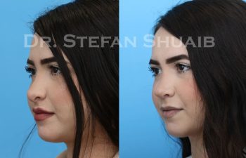 female patient before and after revision rhinoplasty