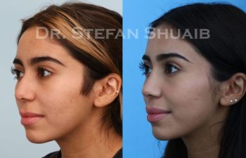 female patient before and after Rhinoplasty