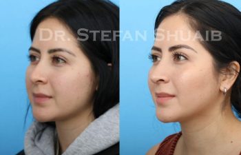 female patient before and after Rhinoplasty