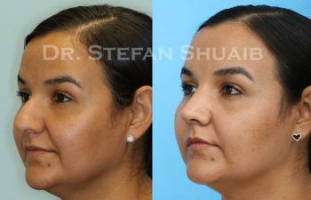 female patient before and after Rhinoplasty