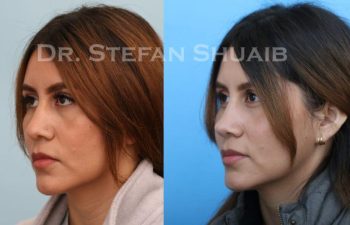 female patient before and after Rhinoplasty