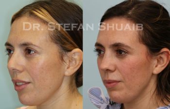 female patient before and after Rhinoplasty