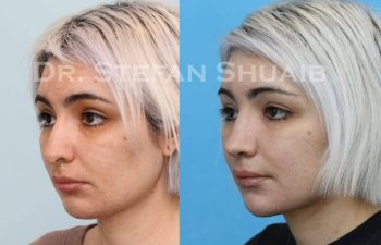 female patient before and after Rhinoplasty