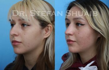 female patient before and after Rhinoplasty