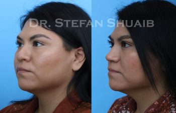 female patient before and after Rhinoplasty