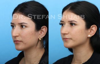 female patient before and after Rhinoplasty