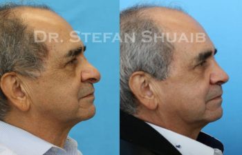 male patient before and after Rhinoplasty