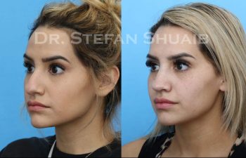 female patient before and after Rhinoplasty