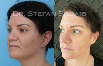 female patient before and after revision rhinoplasty