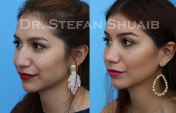 female patient before and after Rhinoplasty