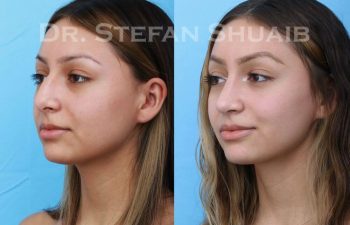 female patient before and after Rhinoplasty