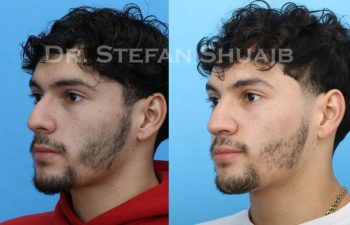 male patient before and after Rhinoplasty