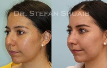 female patient before and after Rhinoplasty