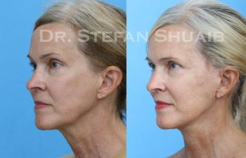 female patient before and after Facial Rejuvenation