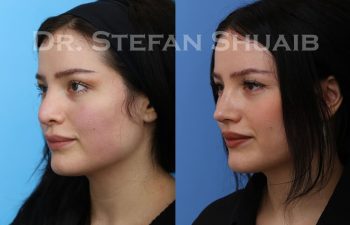 female patient before and after revision rhinoplasty