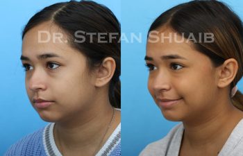 female patient before and after revision rhinoplasty