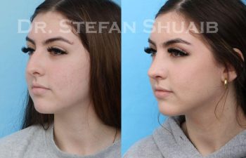 female patient before and after Rhinoplasty