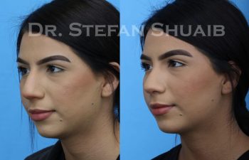 female patient before and after Rhinoplasty