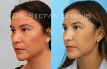 female patient before and after Rhinoplasty